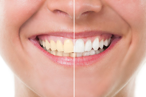 Professional Teeth Whitening Denver and Englewood