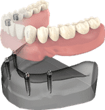 Dental implant model showing teeth restoration on jawbone structure for implant dentistry education.