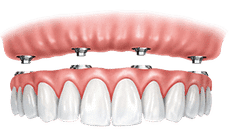 Dental implant crown restoration showing gum tissue and tooth structure placement diagram.