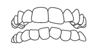 Line drawing of upper and lower teeth showing dental alignment and bite relationship.