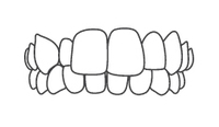 Orthodontic braces diagram showing upper and lower teeth alignment with metal brackets and wires.