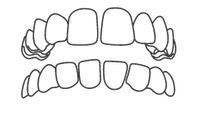 Line drawing of upper and lower teeth showing dental alignment and bite relationship.