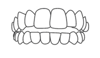 Line drawing of upper and lower teeth showing dental alignment and bite anatomy.