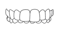 Clear orthodontic aligners or dental braces shown in frontal view against white background.