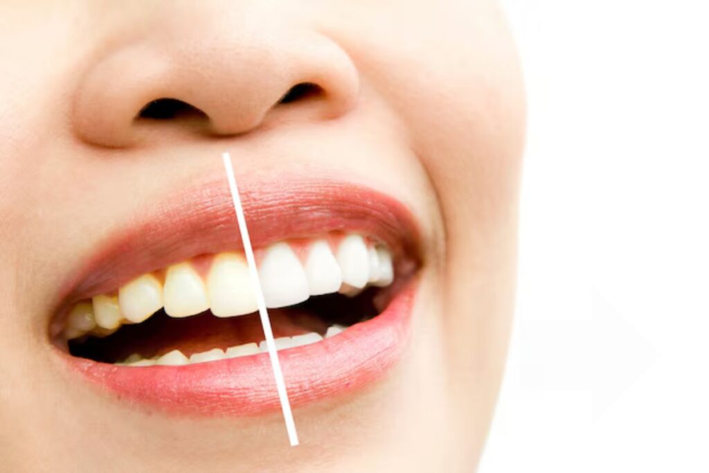 Should I Brush My Teeth Before Using Whitening Strips